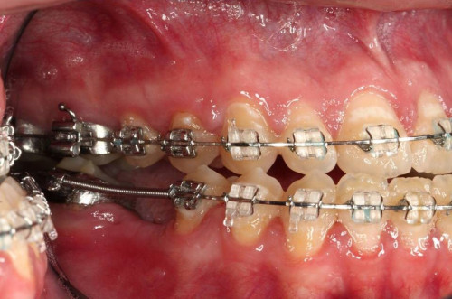 Makroskopie - intraoral 3 präoperativ