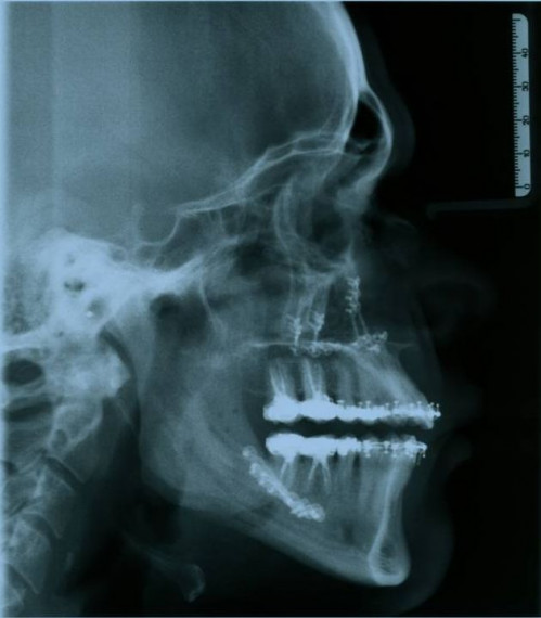 Bildgebung - FRS postoperativ