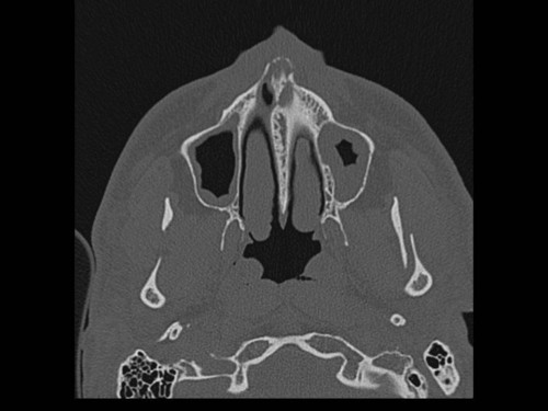 Bildgebung - CT axial präoperativ