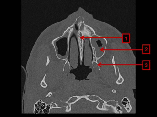 Bildgebung - CT axial präoperativ