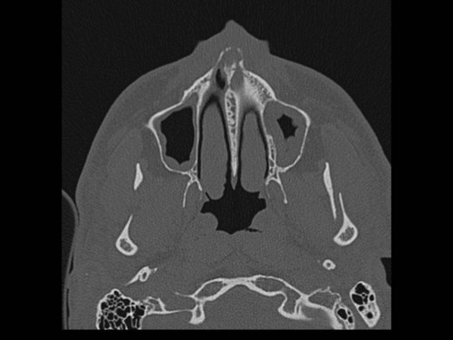 Bildgebung - CT axial präoperativ