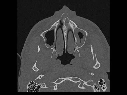 Bildgebung - CT axial präoperativ