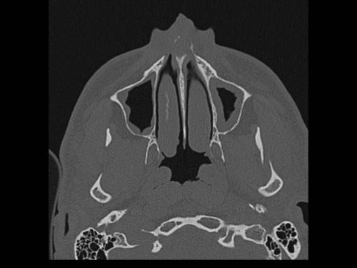 Bildgebung - CT axial präoperativ