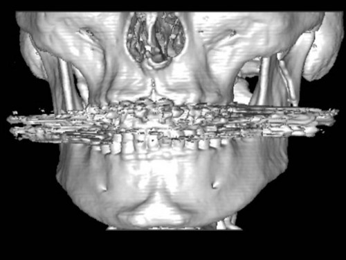 Bildgebung - 3D CT präoperativ