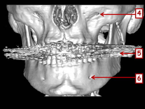 Bildgebung - 3D CT präoperativ