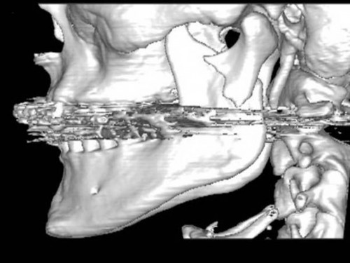Bildgebung - 3D CT präoperativ