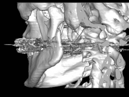 Bildgebung - 3D CT präoperativ