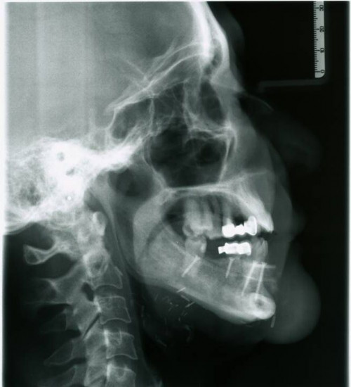 Bildgebung - FRS postoperativ