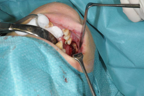 Makroskopie - intraoperativ