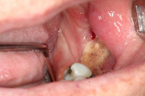 Makroskopie - intraoral präoperativ