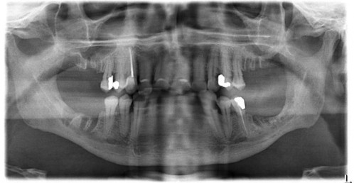 Bildgebung - OPAN postoperativ