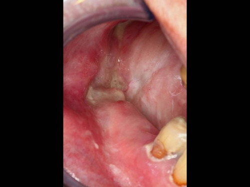Makroskopie - intraoral präoperativ