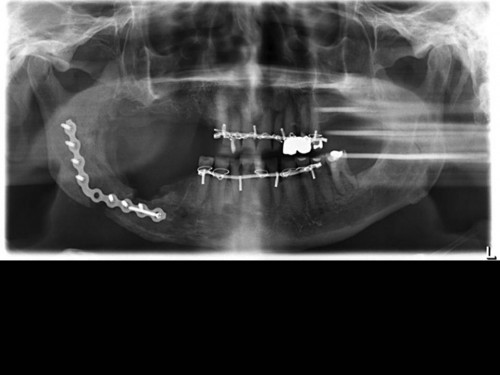 Bildgebung - OPAN postoperativ OP 1