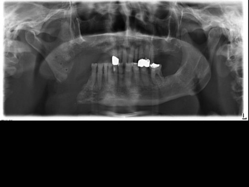 Bildgebung - OPAN postoperativ OP 2