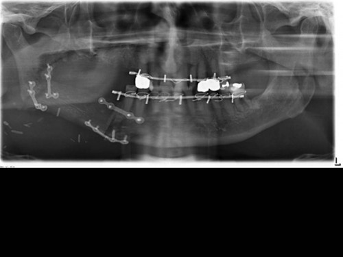 Bildgebung - OPAN postoperativ OP 3