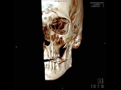 Bildgebung - 3D CT präoperativ