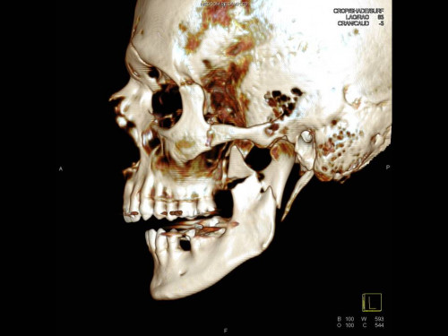 Bildgebung - 3D CT präoperativ
