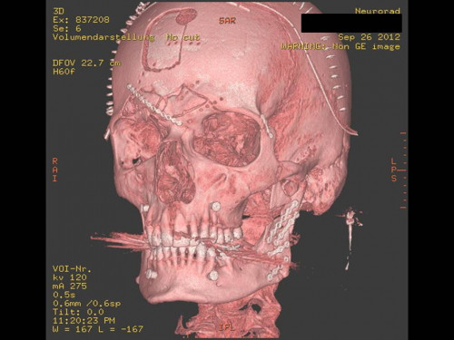 Bildgebung - 3D CT postoperativ