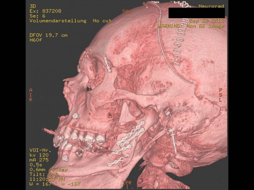Bildgebung - 3D CT postoperativ