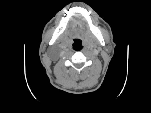 Bildgebung - CT axial präoperativ