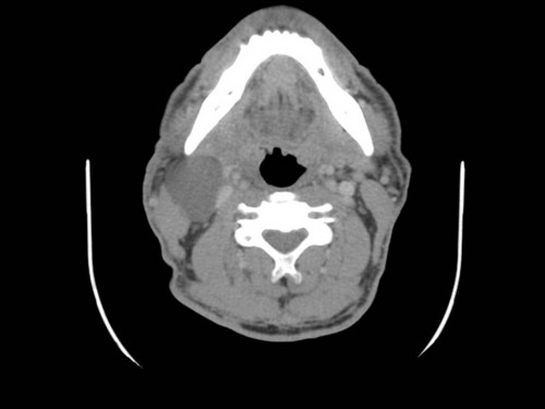 Bildgebung - CT axial präoperativ