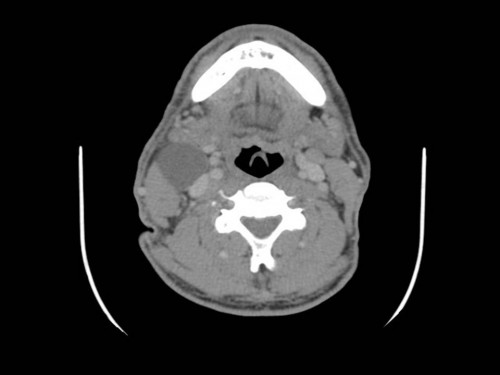 Bildgebung - CT axial präoperativ