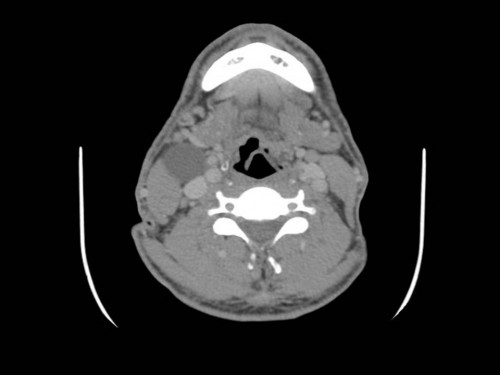 Bildgebung - CT axial präoperativ
