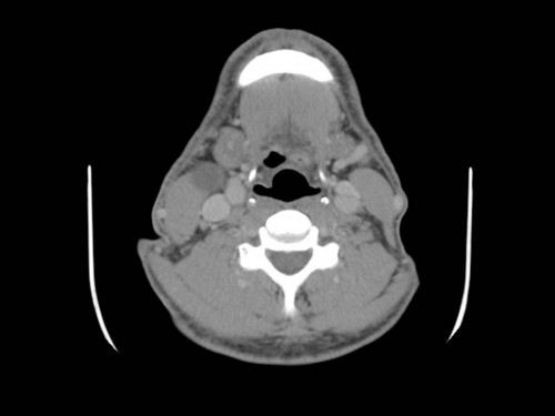 Bildgebung - CT axial präoperativ