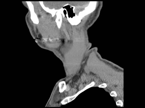 Bildgebung - CT sagittal präoperativ