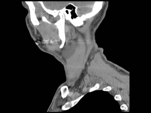 Bildgebung - CT sagittal präoperativ