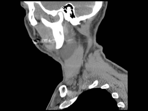Bildgebung - CT sagittal präoperativ
