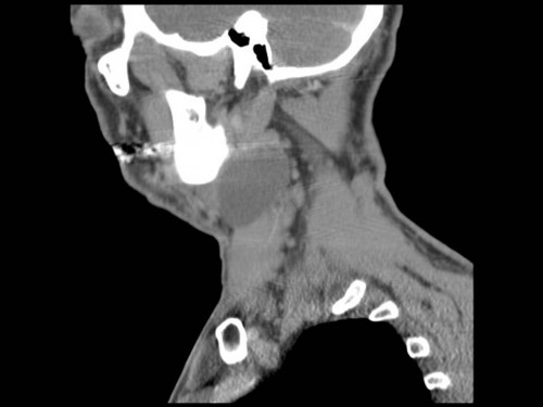 Bildgebung - CT sagittal präoperativ
