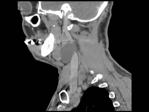 Bildgebung - CT sagittal präoperativ
