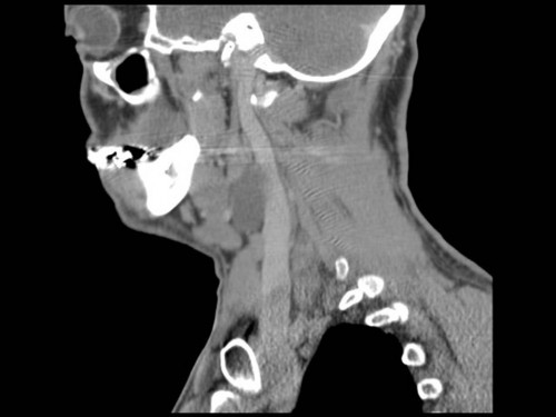 Bildgebung - CT sagittal präoperativ