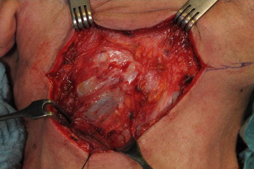 Makroskopie - intraoral intraoperativ 1