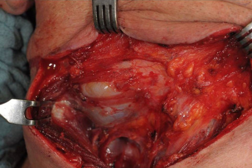 Makroskopie - intraoral intraoperativ 2