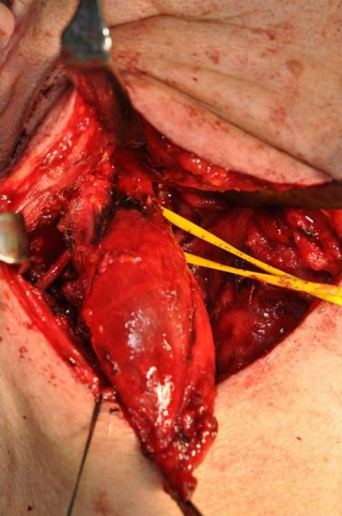 Makroskopie - intraoral intraoperativ 3