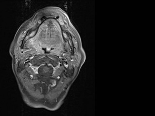 Bildgebung - MRT (axial) präoperativ