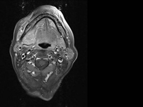 Bildgebung - MRT (axial) präoperativ
