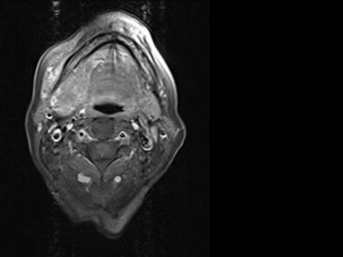 Bildgebung - MRT (axial) präoperativ