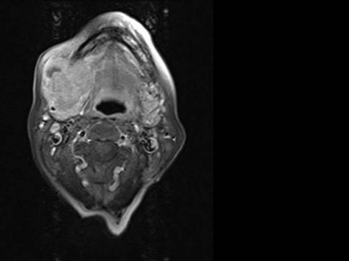 Bildgebung - MRT (axial) präoperativ