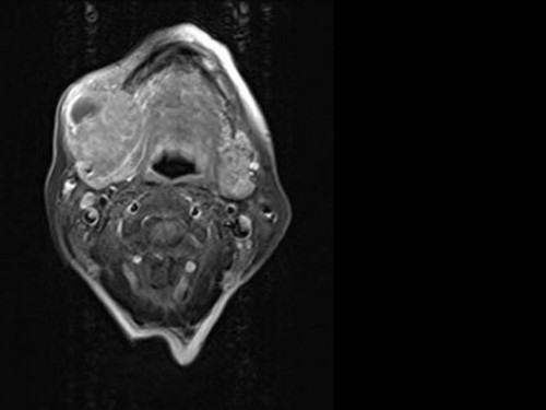 Bildgebung - MRT (axial) präoperativ