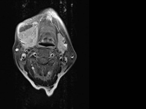 Bildgebung - MRT (axial) präoperativ