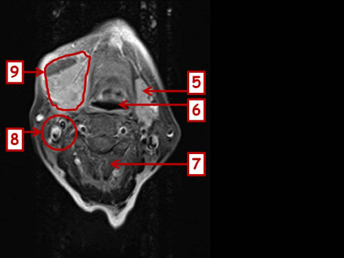 Bildgebung - MRT (axial) präoperativ