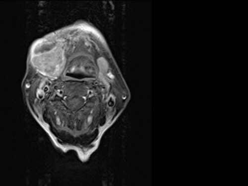 Bildgebung - MRT (axial) präoperativ
