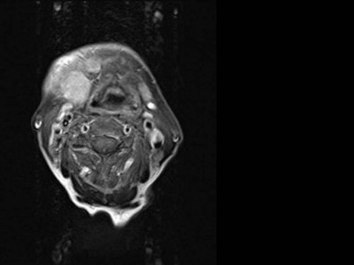 Bildgebung - MRT (axial) präoperativ