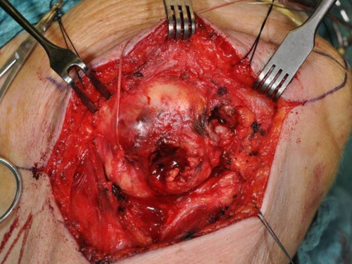 Makroskopie - intraoral intraoperativ