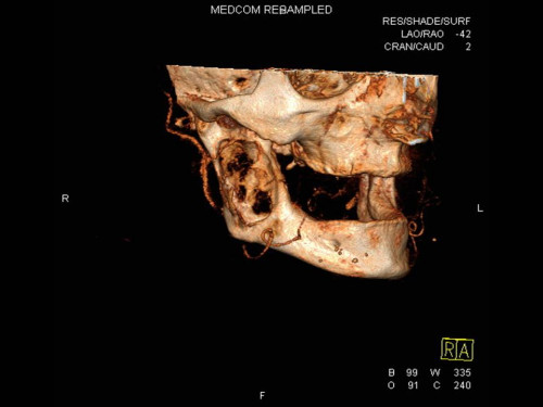 Bildgebung - 3D-CT präoperativ