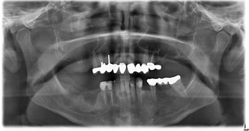 Bildgebung - OPAN postoperativ