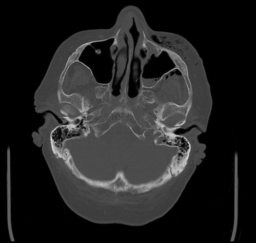 Bildgebung - CT axial präoperativ